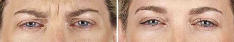 Xeomin® Aesthetic injections before & After