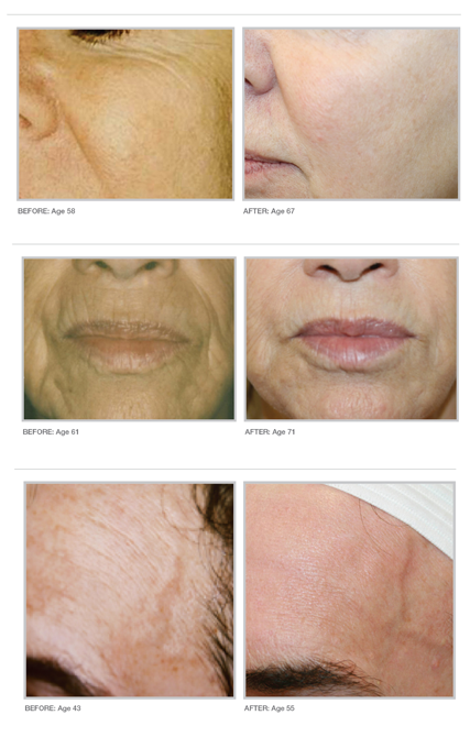 Gene X before & After
