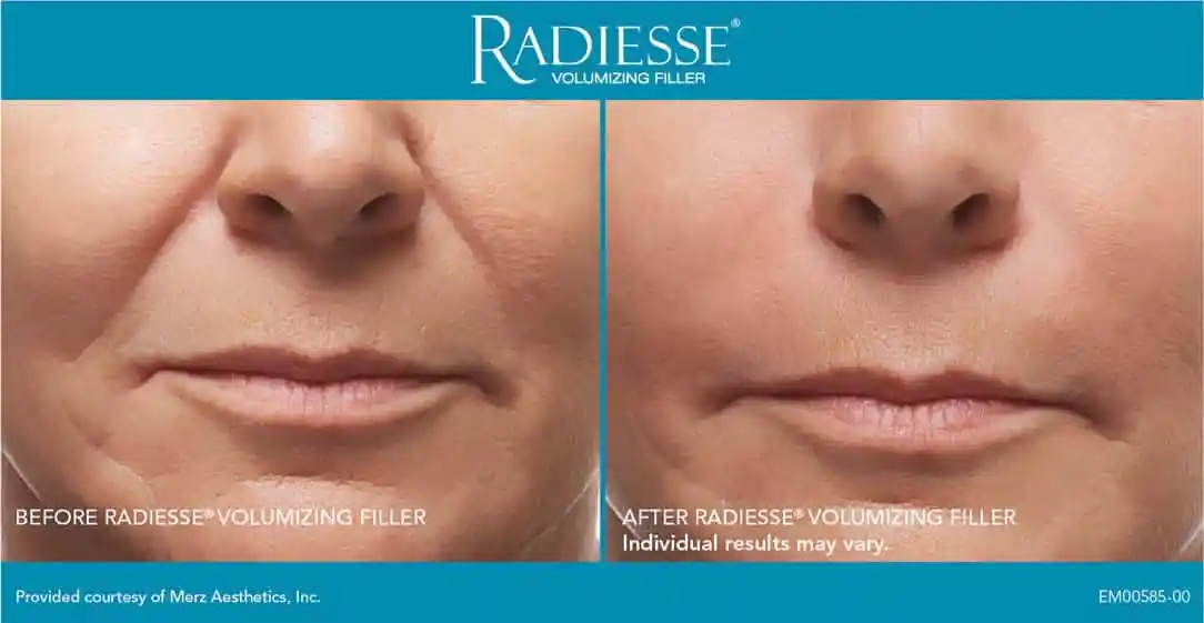 Radiesse before & After