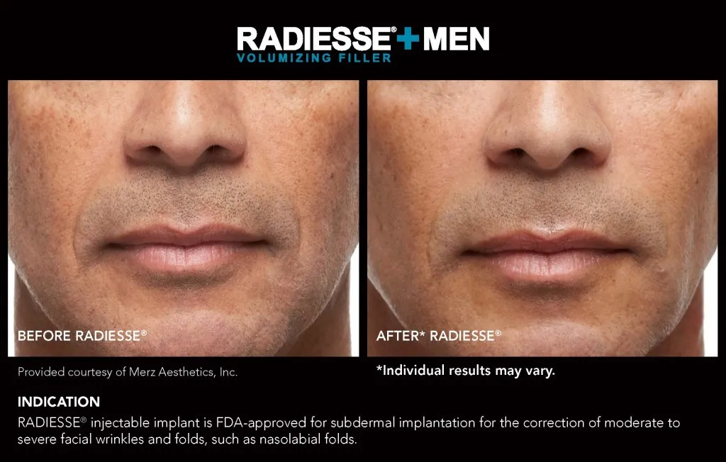 Radiesse before & After