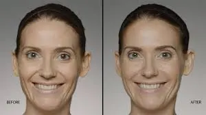 Restylane before & After