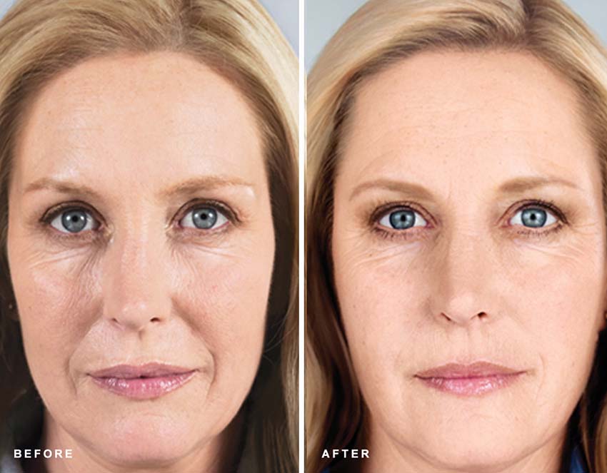 Scultpra procedure patient before and after photo