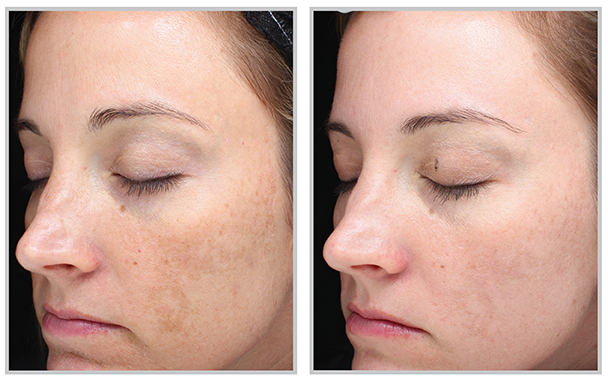 Melasma Treatment before & After