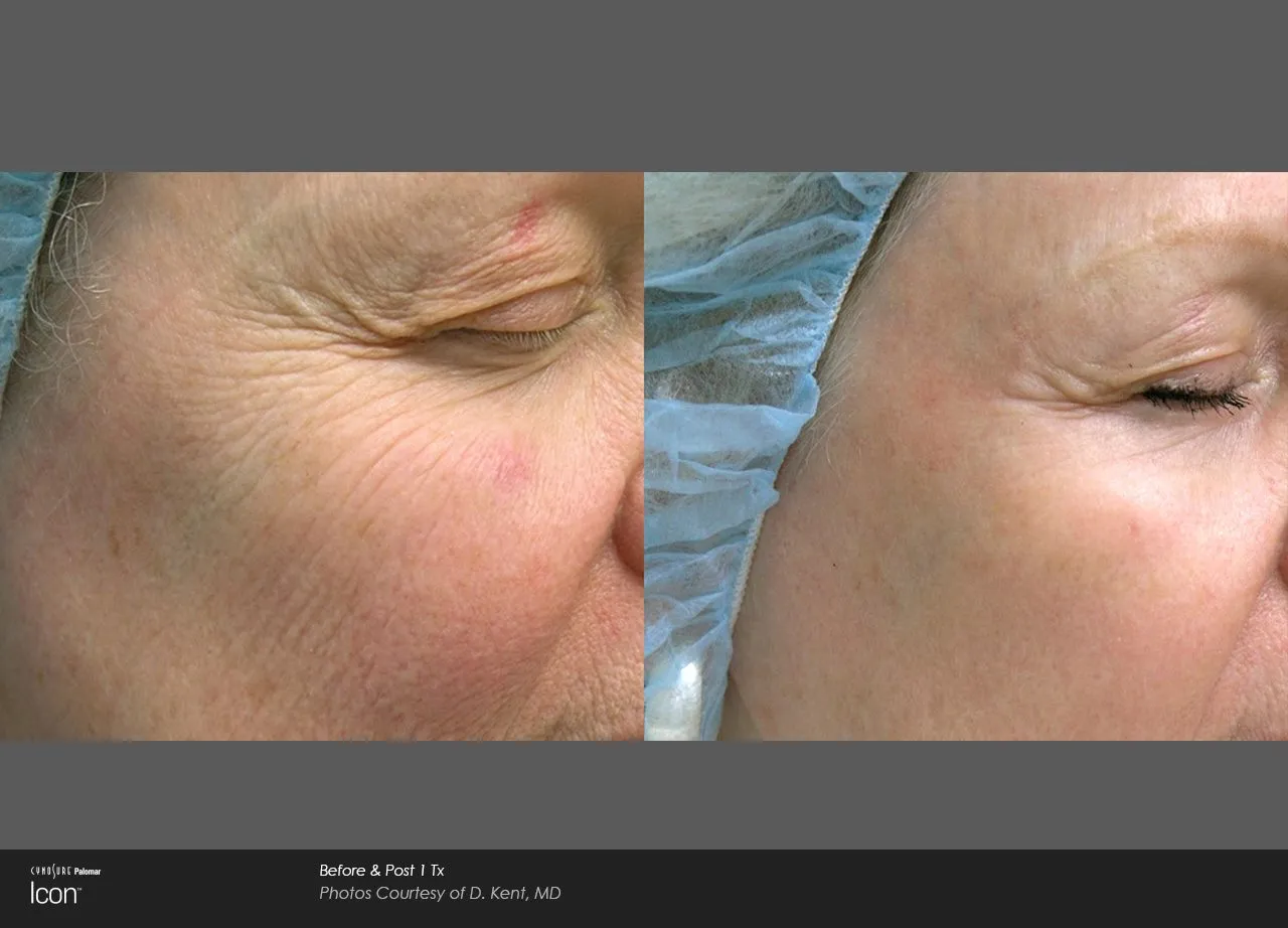 Skin Resurfacing before & After