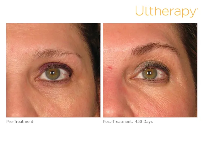 Ultherapy before & After