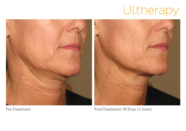 Ultherapy before & After