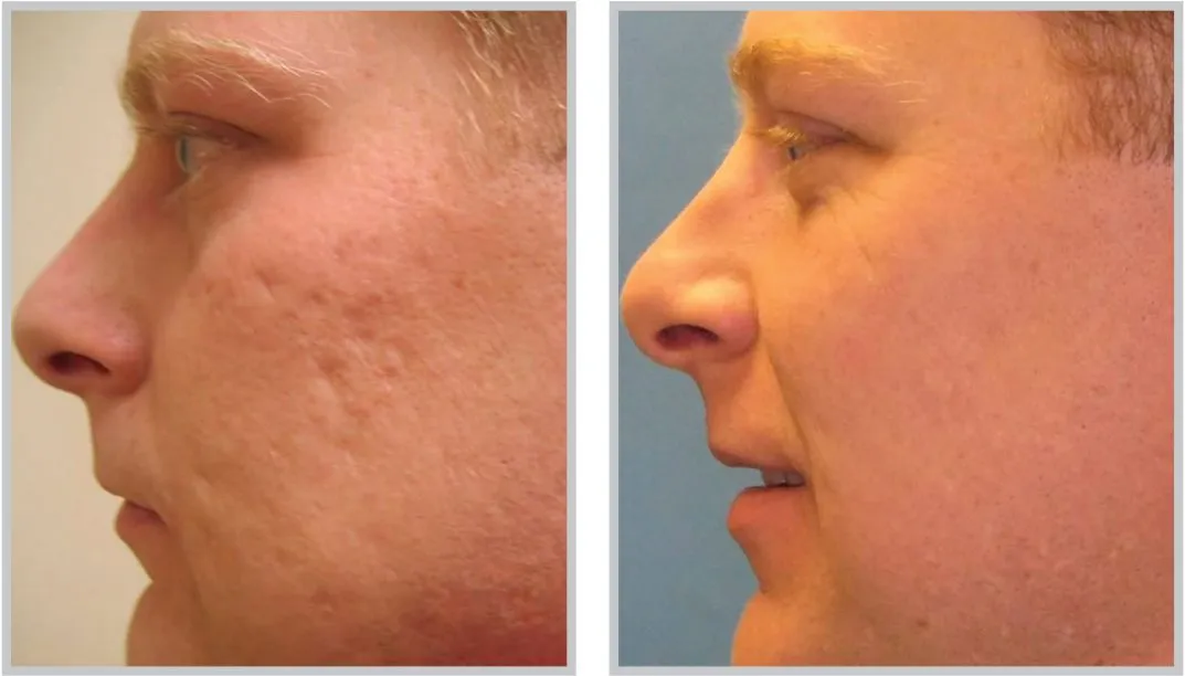 Nano Peel before & After