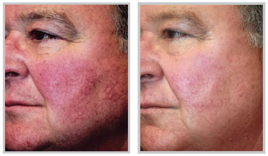Rosacea Treatment before & After