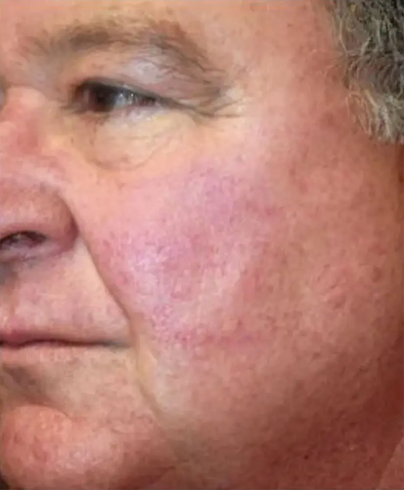 Patient with Rosacea condition after treatment at Renu Medispa