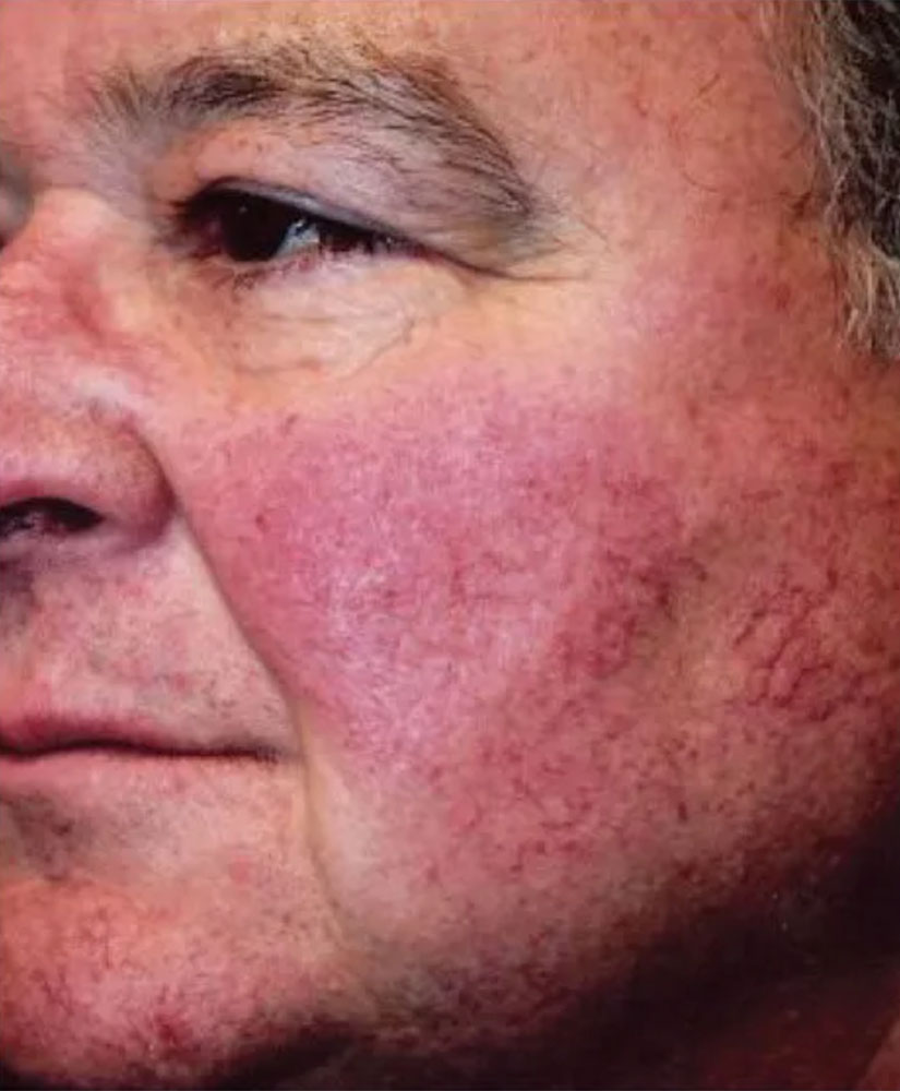 Patient with Rosacea condition before treatment at Renu Medispa
